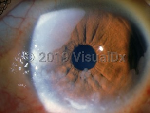 Ophthalmic Imaging image of Corneoconjunctival squamous cell carcinoma - imageId=2989356. Click to open in gallery. 