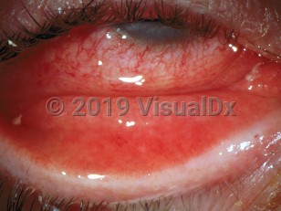 Ophthalmic Imaging image of Allergic conjunctivitis - imageId=2991091. Click to open in gallery. 