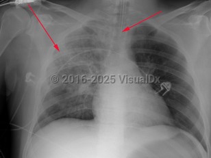 Imaging Studies image of Staphylococcus aureus pneumonia - imageId=2997983. Click to open in gallery.  caption: 'AP supine chest x-ray demonstrating a diffuse right-sided opacity which&nbsp;may be&nbsp;related to layering of a pleural effusion. In addition, there are poorly defined nodular opacities on the right, (long arrow). Endotracheal tube is present, (short arrow).'