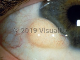 Ophthalmic Imaging image of Epibulbar dermoid cyst - imageId=3103756. Click to open in gallery.  caption: 'A yellowish-white, firm, rounded, fleshy papule at the limbus.'