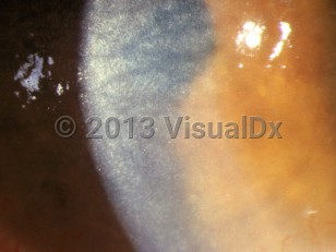 Ophthalmic Imaging image of Cystinosis - imageId=3105948. Click to open in gallery. 