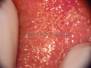 Clinical image of Vestibular papillomatosis - imageId=313500. Click to open in gallery.  caption: 'A close-up of many tiny papules on the vulval mucosa.'