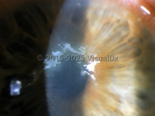 Ophthalmic Imaging image of Herpes zoster ophthalmicus - imageId=3149677. Click to open in gallery.  caption: 'Pseudodendrites on the cornea.'