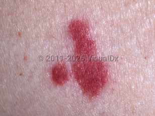 Vasculitis