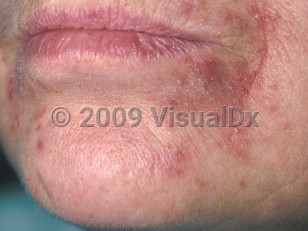 Clinical image of Periorificial dermatitis - imageId=326179. Click to open in gallery.  caption: 'Multiple tiny erythematous papules coalescing to form a plaque, with minimal scale at the oral commissure. Note the sparing of the lip margin.'