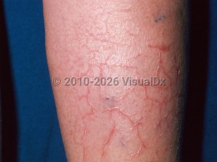 Eczema craquelé