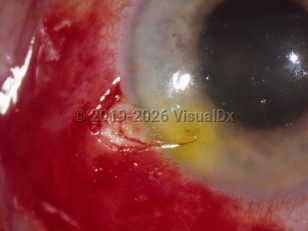 Ophthalmic Imaging image of Scleral laceration - imageId=3389882. Click to open in gallery. 