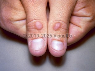 Clinical image of Knuckle pads - imageId=35819. Click to open in gallery.  caption: 'Pink, scaly papules over the distal interphalangeal joints.'
