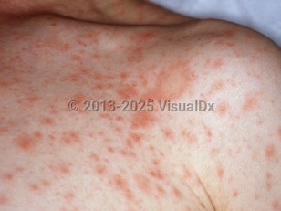 Clinical image of Pityriasis rosea - imageId=3696704. Click to open in gallery.  caption: 'Multiple erythematous papules and a larger annular plaque ("herald patch") on the chest.'