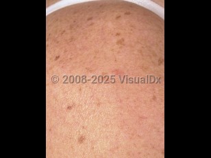 Clinical image of Familial leiomyomatosis cutis et uteri - imageId=3789056. Click to open in gallery.  caption: 'Faint pink papules on the shoulder (leiomyomas). Note the unrelated lentigines secondary to sun damage.'