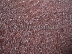Clinical image of Tinea imbricata - imageId=412232. Click to open in gallery.  caption: 'A close-up of patterned peeling scales.'