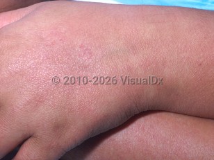 Clinical image of Scarlet fever - imageId=426336. Click to open in gallery.  caption: 'Patchy erythema on the hand and wrist.'