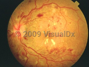 Ophthalmic Imaging image of Diabetic retinopathy - imageId=4377187. Click to open in gallery. 