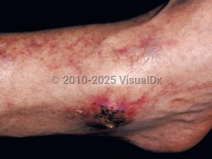 Clinical image of Cryoglobulinemia - imageId=43785. Click to open in gallery.  caption: 'Purpuric macules on the leg and an eschar overlying a purpuric plaque on the ankle.'
