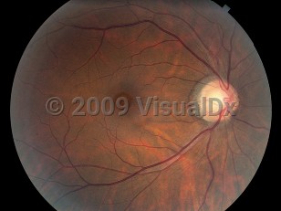 Ophthalmic Imaging image of Macular hole - imageId=4380541. Click to open in gallery. 