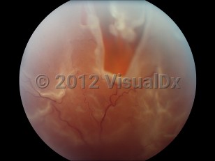 Ophthalmic Imaging image of Retinal tear - imageId=4382977. Click to open in gallery. 