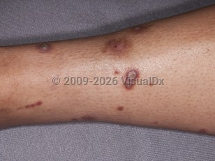 Chronic kidney disease