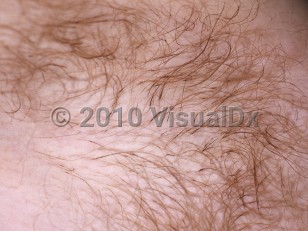Clinical image of Black piedra - imageId=4717788. Click to open in gallery.  caption: 'A close-up of adherent black concretions around terminal hairs.'