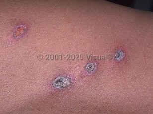 Clinical image of Histoplasmosis - imageId=475939. Click to open in gallery.  caption: 'Eroded and crusted plaques on the arm of a patient with AIDS.'