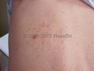 Clinical image of IgA pemphigus - imageId=4861184. Click to open in gallery.  caption: 'A reddish plaque on the back.'
