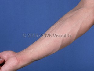 Clinical image of Drug-induced lipodystrophy - imageId=512261. Click to open in gallery.  caption: 'Loss of subcutaneous fat affecting the arm of a patient with AIDS on antiretroviral therapy.'