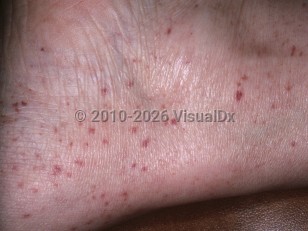 Clinical image of Hyperglobulinemic purpura of Waldenström - imageId=5144640. Click to open in gallery.  caption: 'Purpuric macules and papules around the ankle.'