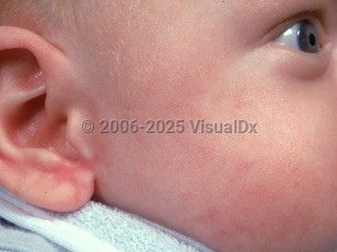 Clinical image of Hereditary acrodermatitis enteropathica - imageId=524030. Click to open in gallery.  caption: 'Patchy erythema on the cheek and ear.'