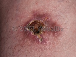 Clinical image of Epithelioid sarcoma - imageId=5615696. Click to open in gallery.  caption: 'A close-up of a violaceous, ulcerated and crusted plaque with an atrophic portion.'
