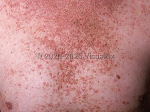 Clinical image of Darier disease - imageId=570062. Click to open in gallery.  caption: 'Hundreds of confluent, reddish-brown, scaly papules forming plaques on the upper chest.'