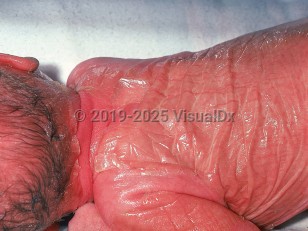 Clinical image of Collodion baby - imageId=579365. Click to open in gallery.  caption: 'Diffuse erythema with overlying shiny, wrinkled, membrane-like plaques on the scalp, neck, back, and arms.'