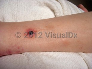 Clinical image of Paecilomyces lilacinus infection - imageId=6113352. Click to open in gallery.  caption: 'An erythematous plaque with a central eschar and a cluster of pink papules on the leg.'