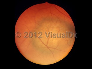 Ophthalmic Imaging image of Choroidal melanoma - imageId=6207061. Click to open in gallery. 