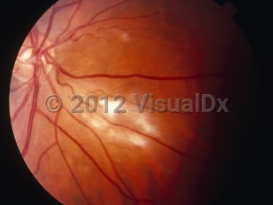 Ophthalmic Imaging image of Cytomegalovirus retinitis - imageId=6210113. Click to open in gallery. 