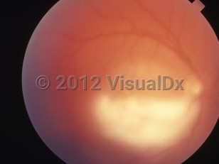 Ophthalmic Imaging image of Toxoplasmosis - imageId=6210403. Click to open in gallery. 