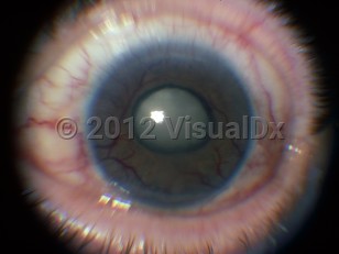 Ophthalmic Imaging image of Neovascular glaucoma - imageId=6212977. Click to open in gallery. 