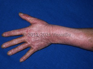 Chronic actinic dermatitis