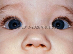 Clinical image of Pseudoesotropia - imageId=6773257. Click to open in gallery.  caption: 'A flat nasal bridge obscuring the nasal sclera, producing the appearance of esotropia.'