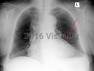 Imaging Studies image of Pericarditis - imageId=6789416. Click to open in gallery.  caption: '<span>Frontal view from chest x-ray demonstrating cardiomegaly in a patient with a history of pericardits.</span>'