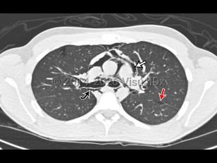 Pneumomediastinum