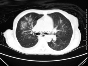 Respiratory syncytial virus infection