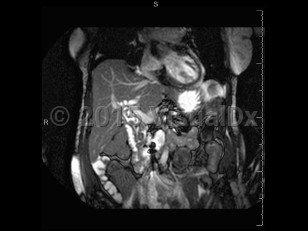 Imaging Studies image of Acute cholangitis - imageId=6839360. Click to open in gallery.  caption: '<span>MRCP image demonstrates  numerous fililng defects in the dilated extrahepatic biliary tree.  Purulent material was found during ERCP. Findings consistent with  cholangitis.</span>'