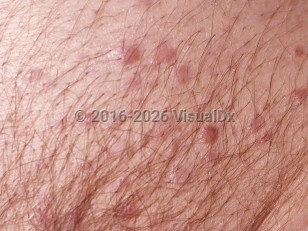 Non-Hodgkin lymphoma