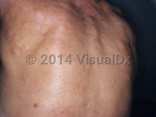 Clinical image of Familial cutaneous collagenoma syndrome - imageId=7302815. Click to open in gallery.  caption: 'Multiple skin-colored subcutaneous nodules on the back.'