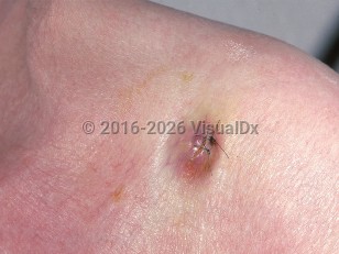 Clinical image of Metastatic adenocarcinoma - imageId=730810. Click to open in gallery.  caption: 'A violaceous nodule near the shoulder (metastatic colon carcinoma).'