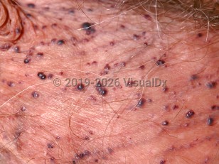 Clinical image of Fordyce angiokeratoma of scrotum - imageId=73207. Click to open in gallery.  caption: 'A close-up of multiple maroon and dark purple scrotal papules of varying sizes.'