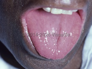 Vitamin B2 deficiency