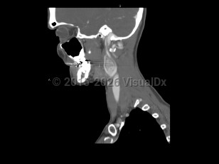 Carotid body tumor