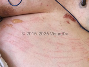 Acute edema blister