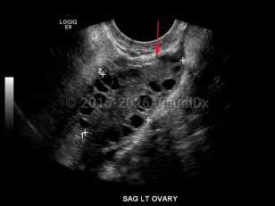 Polycystic ovarian syndrome