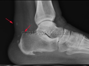 Imaging Studies image of Achilles tendonitis - imageId=7886591. Click to open in gallery.  caption: '<span>Achilles Tendonitis - rupture.  Lateral ankle radiograph demonstrates soft tissue thickening and  multiple, small dystrophic calcifications involving the distal Achilles  tendon compatible with chronic Achilles tendonitis. Note the presence of  a small bony bump along the posterosuperior calcaneus which may be the  early signs of a Haglund deformity.</span>'